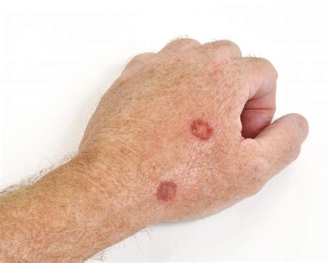 What Are Cutaneous Lesions With Pictures