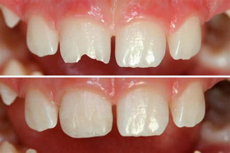 tratamientos de estetica dental clinica dental maip en