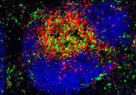 Buruli Ulcer New Diagnostic Avenues For A Neglected Disease Inserm