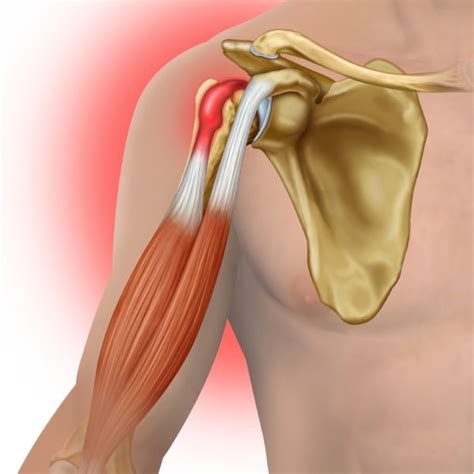 Slipped Biceps Tendon A Commonly Overlooked Cause Of Shoulder Pain