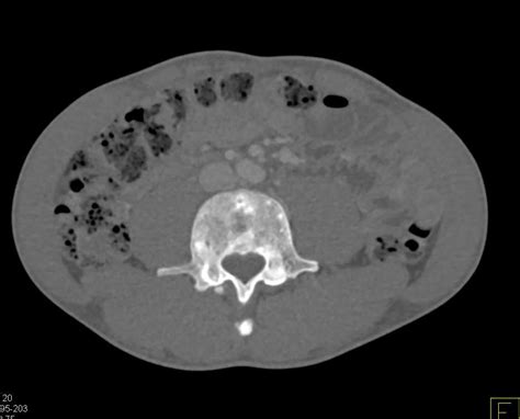 Carcinoid With Blastic Metastases Musculoskeletal Case Studies