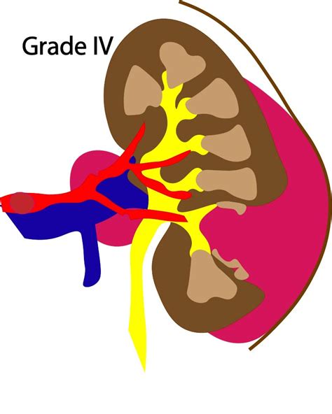 Trauma Right Kidney Laceration Critical Care Sonography
