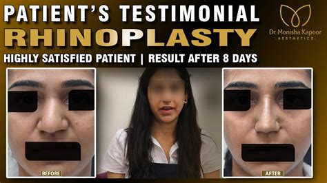 Septoplasty Rhinoplasty In India By Dr Monisha Kapoor Happy Patient Review Youtube