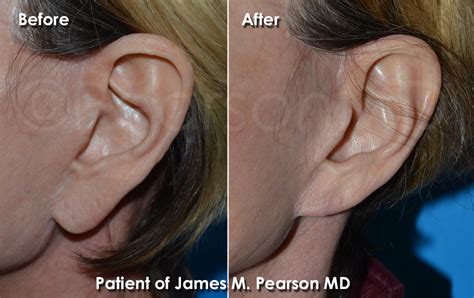 Earlobe Plastic Surgery Photos Before And After Dr James Pearson