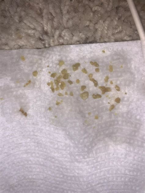 Tonsil Stones These All Just Came Out Of One Of My Tonsils Just Now