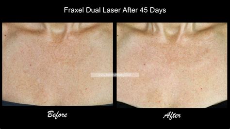 Fraxel Dual Laser Treatment For Sun Damage Chest Neck Before
