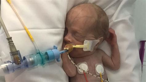 Tiny Premature Baby With Skin So Thin She Was Kept In A Bag Defies