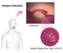 Herpes Simplex Wikipedia The Free Encyclopedia