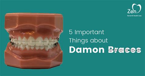 5 Important Things About Damon Braces Zen Dental Health Care