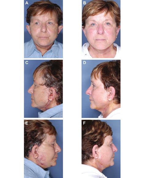 A C E The 41 Year Old Woman Shown In Figure 1 Is Shown 1 Day After Download Scientific