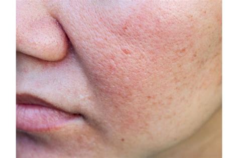 How To Get Rid Of Hormonal Acne Acne Cure