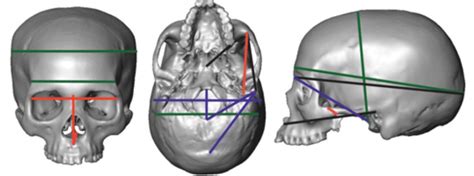 Vista Frontal Lateral E Inferior De Un Cráneo Humano Que Muestra Las
