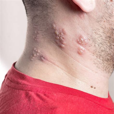 The Connection Between Shingles And Stress Causes Symptoms And