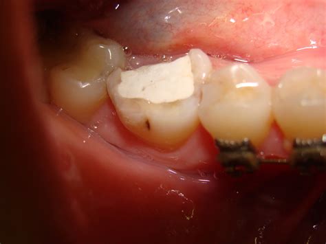 FERRAZ ODONTOLOGIA: RESTAURAÇÃO EM PORCELANA
