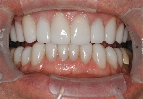 After Crooked And Worn Teeth Advanced Porcelain Veneer Techniques