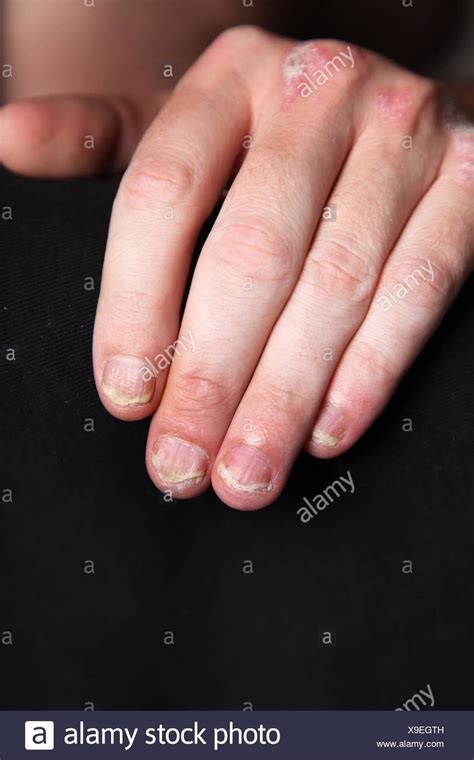 Psoriasis Nails High Resolution Stock Photography And Images Alamy