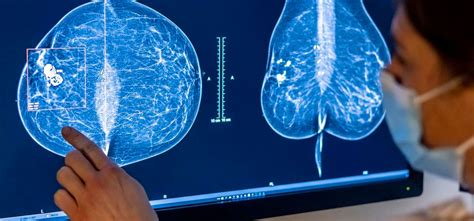 new breast cancer screening guidelines are a step in the right direction but one more step is