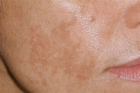 Brown Spots And Melasma Treatments Dermetics