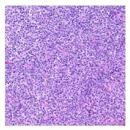 It sometimes causes a rash. Pathology Outlines - Angioimmunoblastic T cell lymphoma