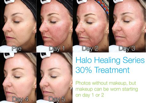 Halo Skin Laser Treatment Resurfacing With Less Downtime