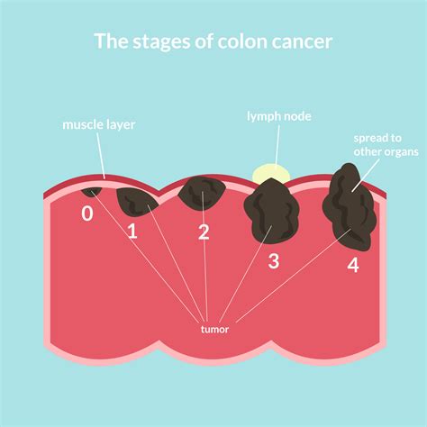 Bowel Cancer Stages 1 To 4 London Dr Jamie Murphy
