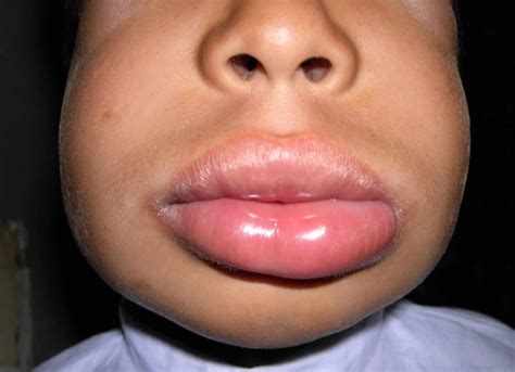 Swollen Uvula Or Uvulitis Causes Symptoms And Swollen Uvula Treatment