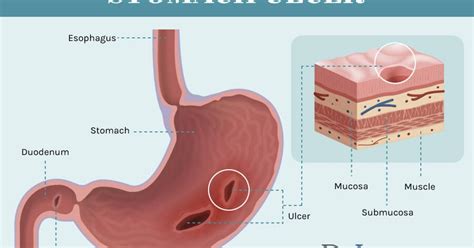 Heal Stomach Ulcer Naturally Part 2 ~ Grace Ngo Foundation