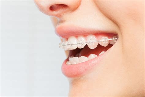 It may not be easy to live with braces, but it will be worth it. How to Brush Your Teeth With Braces: A Simple Guide | Yuba ...