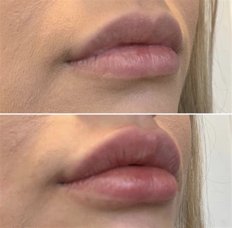 Lip Enhancement