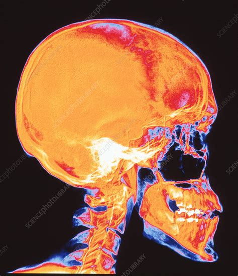 Human Skull Stock Image P1200151 Science Photo Library