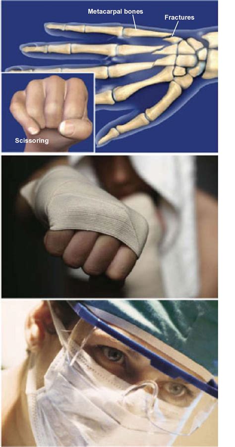 Fractures Of The Hand Metacarpal Fractures