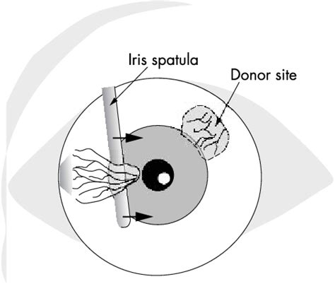 Blunt Dissection Of The Pterygium Head Autotransplant Is Marked At The