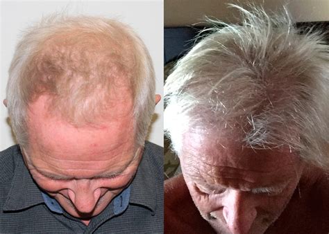 Hair Transplants Can Change Your Life Regardless Of Age