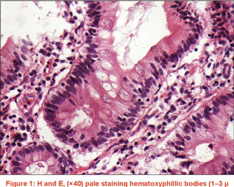 Figure 1 From Microsporidium Infection And Perforation Peritonitis A