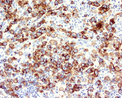 Diffuse Large B Cell Lymphoma Anaplastic Variant 5