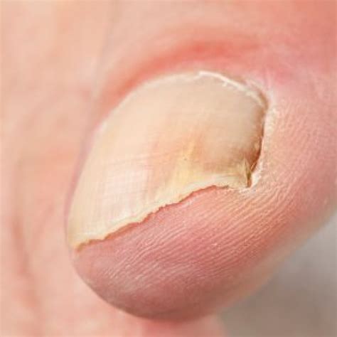 How Long Does It Take Nail Fungus To Go Away