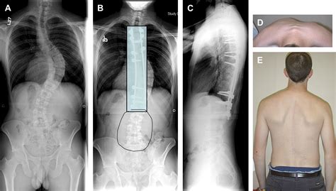 Adolescent Idiopathic Scoliosis Neurosurgery Clinics