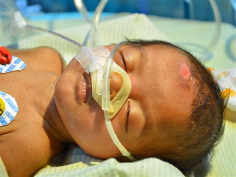 3 Month Old Baby Girl Suffering From Rare Lung Disease Needs Help Milaap