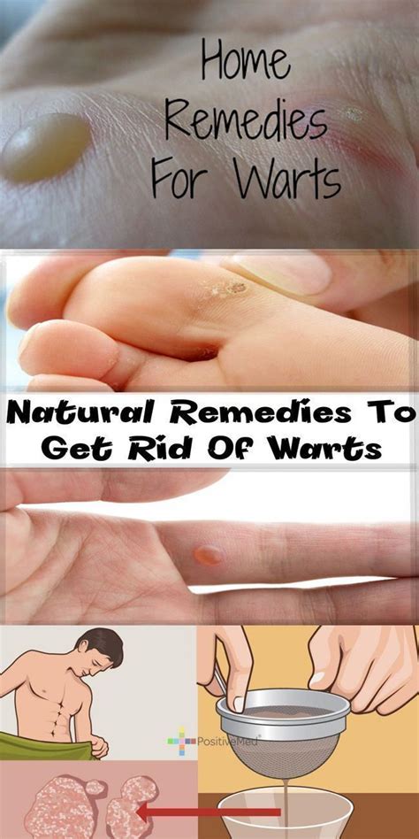 Home Remedies To Get Rid Of Warts Naturally Fast Permanently Home