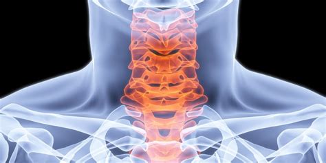 Cervical Myositis Symptoms And Treatment Of Inflammation Of The Neck