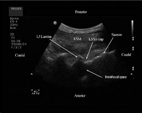 Figure 2 From Real Time Ultrasound Guided Paramedian Epidural Access
