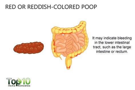 What Your Poop Says About Your Health Top 10 Home Remedies