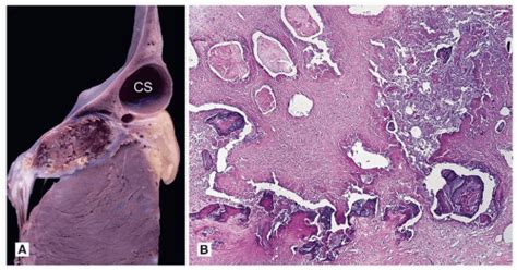 Degenerative Valve Disease Calcific Aortic Stenosis And Mitral Annular