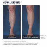 Images of Early Varicose Veins Treatment