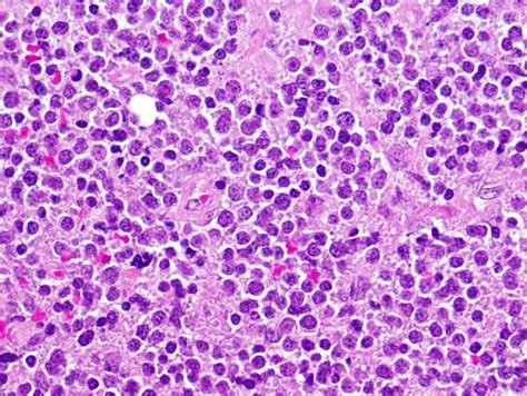 Pathology Outlines Large B Cell Lymphoma With Irf4 Rearrangement