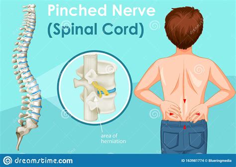 Diagram Showing Back Pain In Human Stock Vector Illustration Of