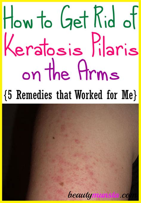 How To Get Rid Of Keratosis Pilaris On Arms Beautymunsta Free