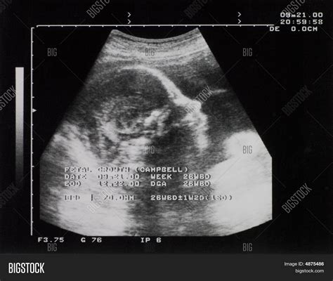 Baby Xray Image And Photo Free Trial Bigstock