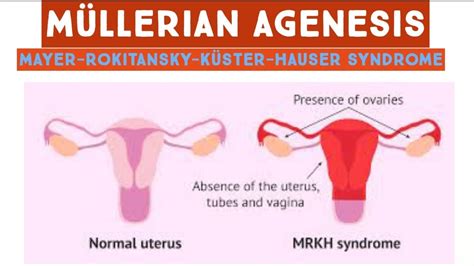 Müllerian agenesis Mayer Rokitansky Küster Hauser syndrome