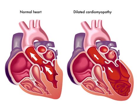 What Are Treatment Options For An Enlarged Heart Kiasalon